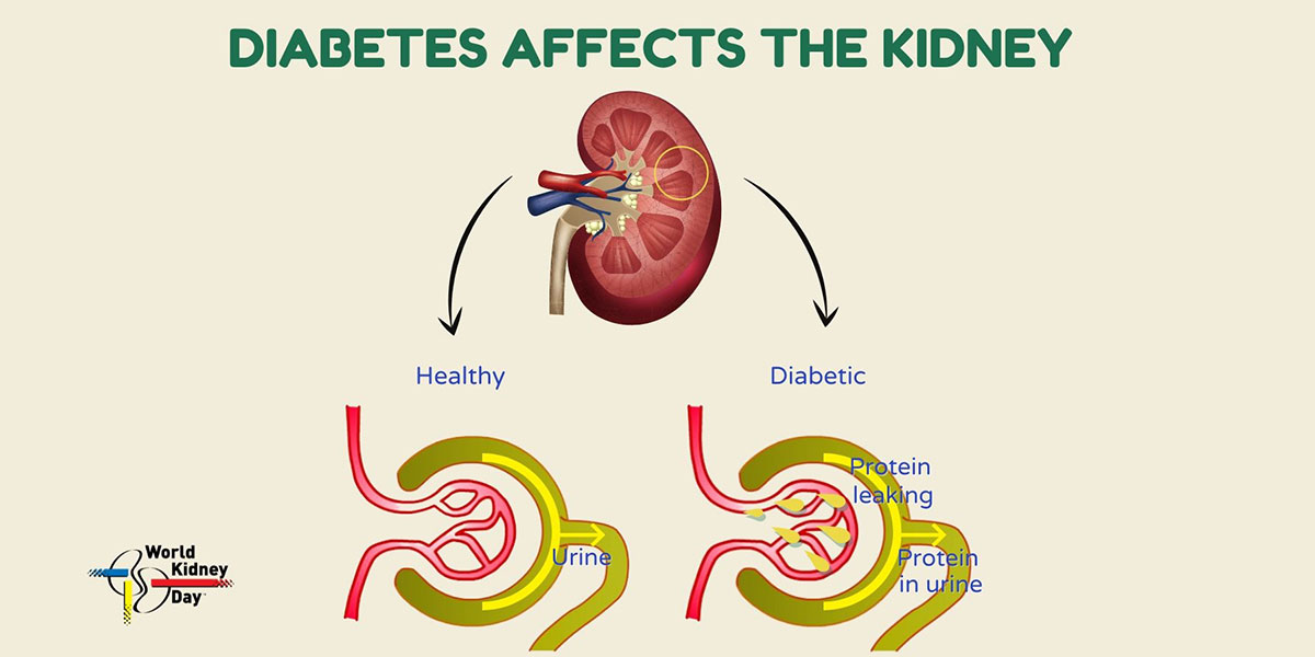 Diabetes is one of the commonest causes of kidney failure worldwide