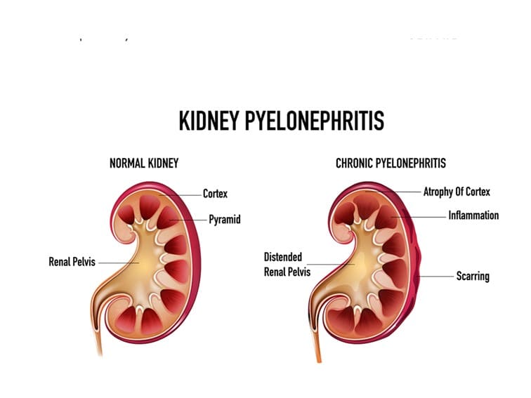 kidney infection pyelonephritis