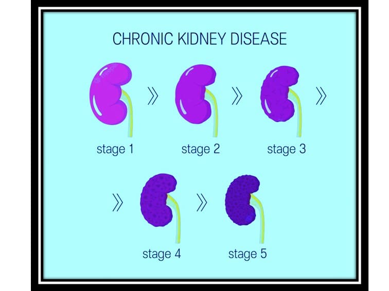 5 stages of kidney disease