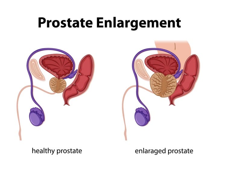 Enlarged Prostate causes