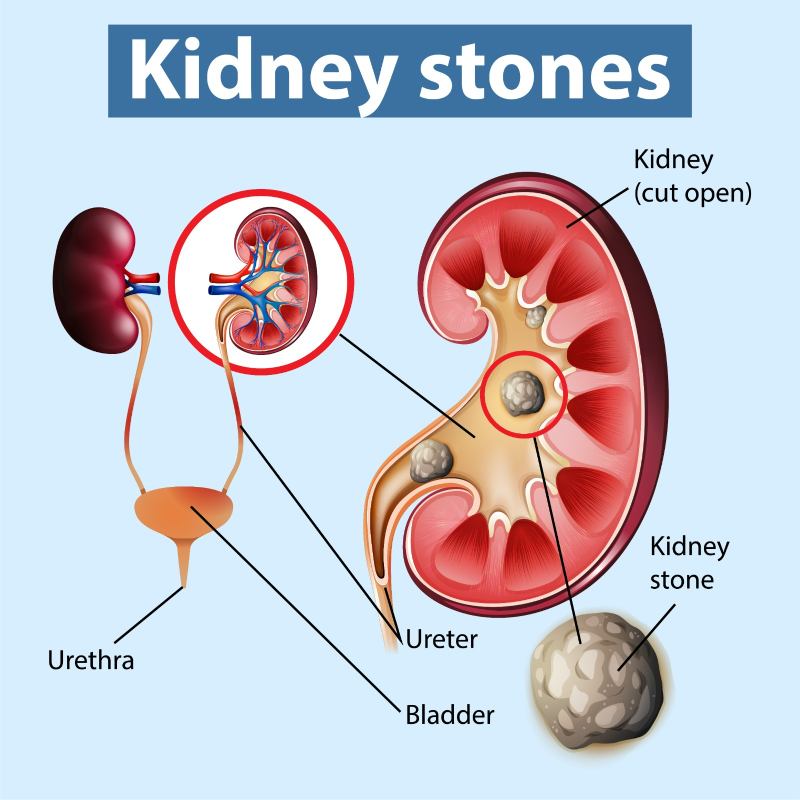 who gets kidney stones