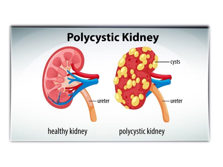 polycystic kidney disease